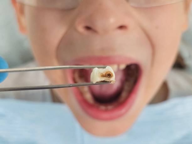 Best Emergency Treatment for Toothache in Merced, CA